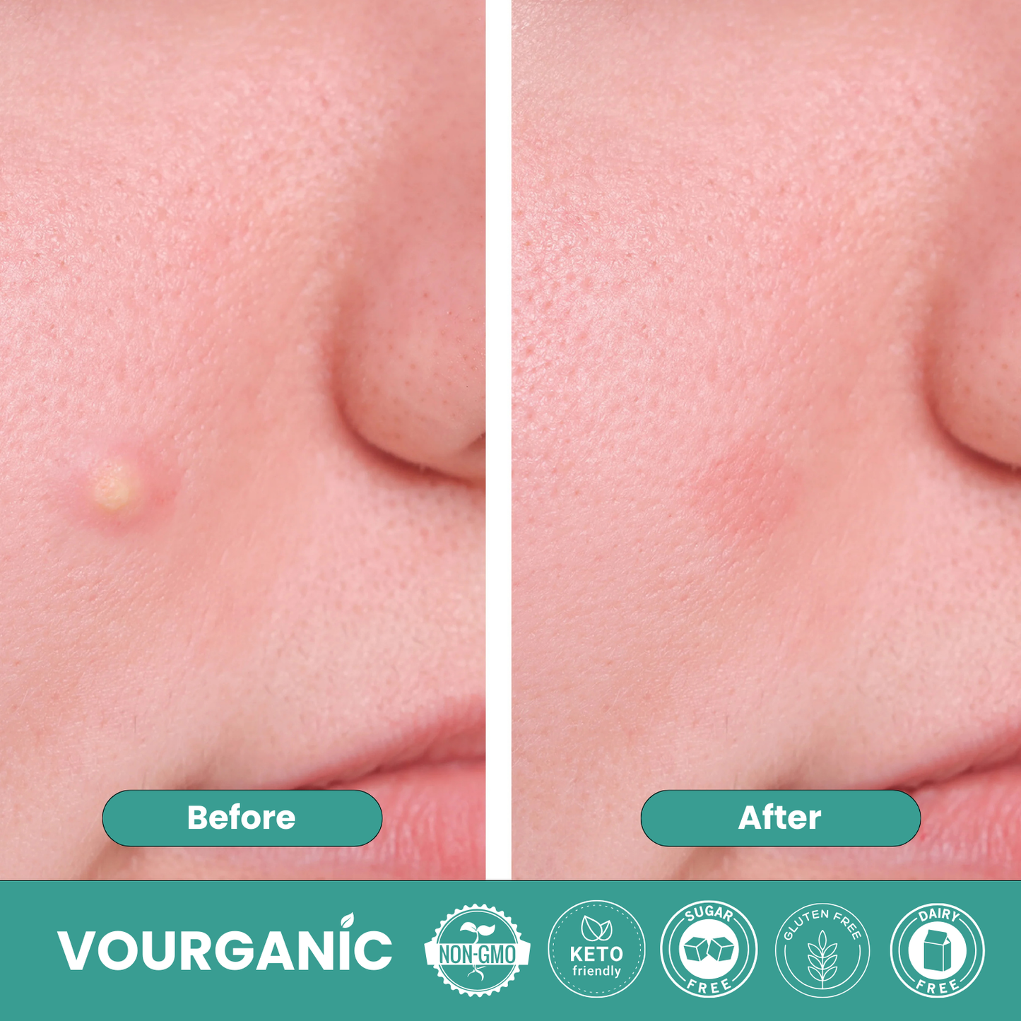 VOURGANIC® Hydrocolloid ClearSkin Roll