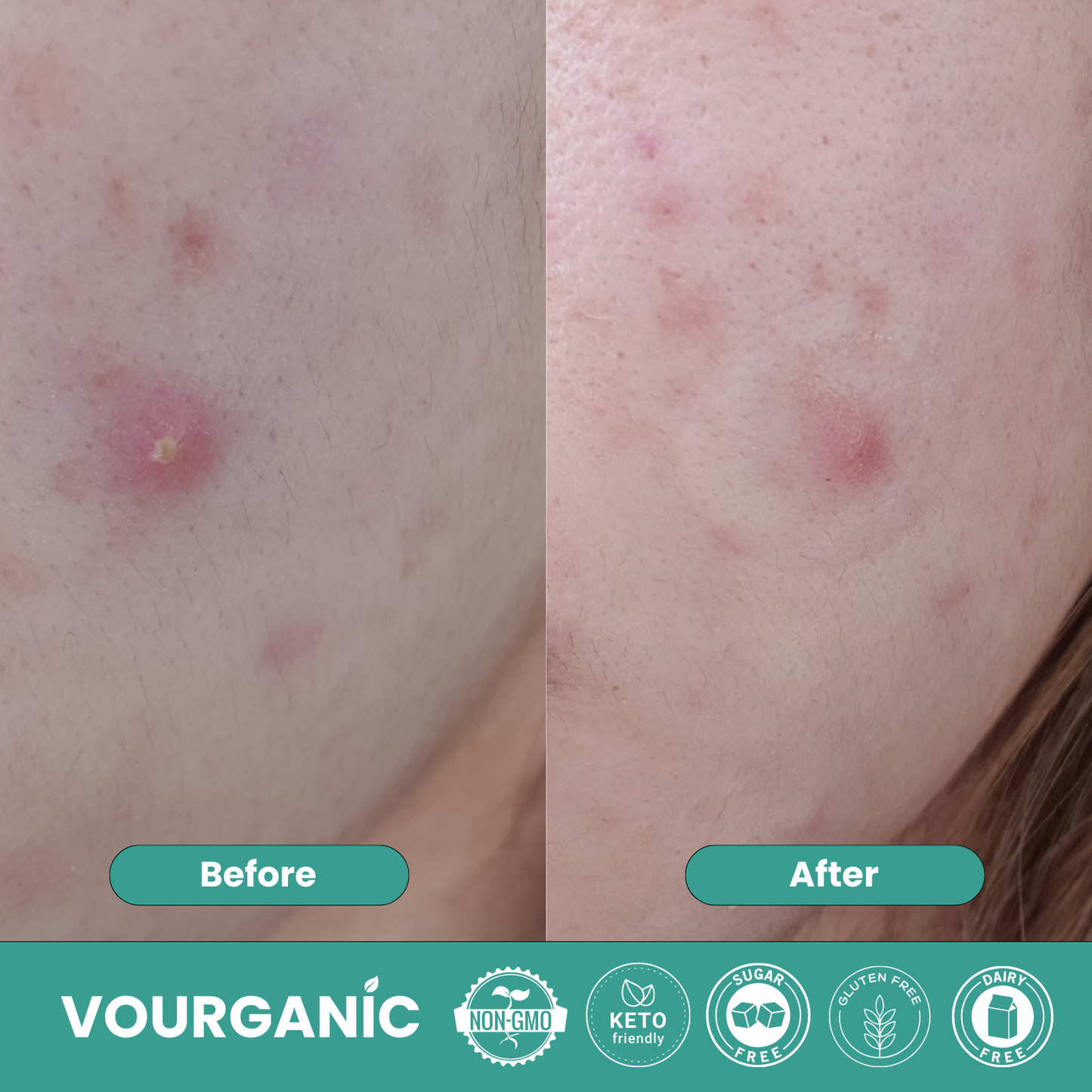 VOURGANIC® Hydrocolloid ClearSkin Roll