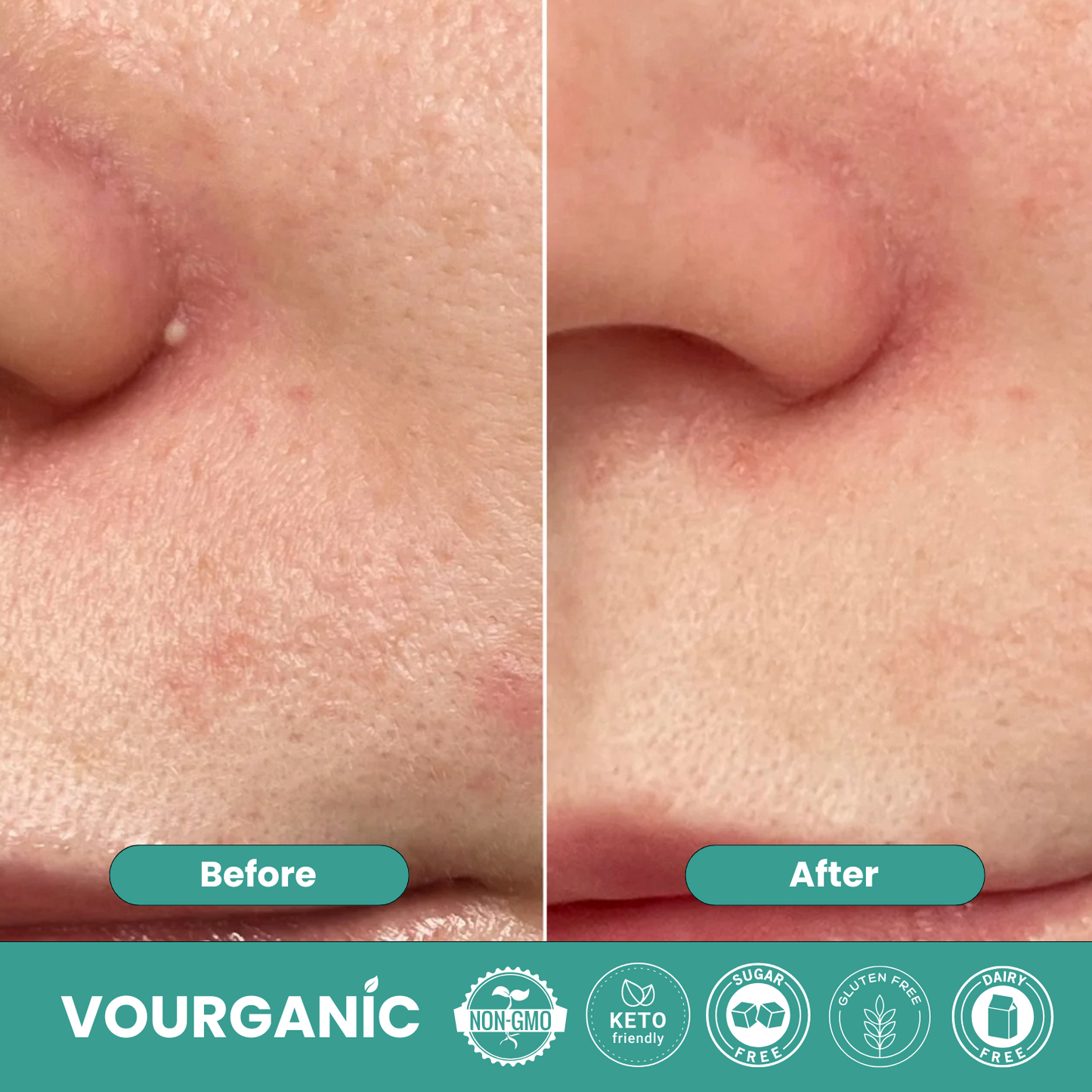VOURGANIC® Hydrocolloid ClearSkin Roll