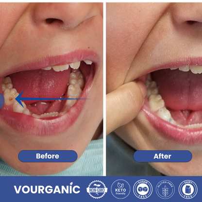 Dentite™ Tooth Armor